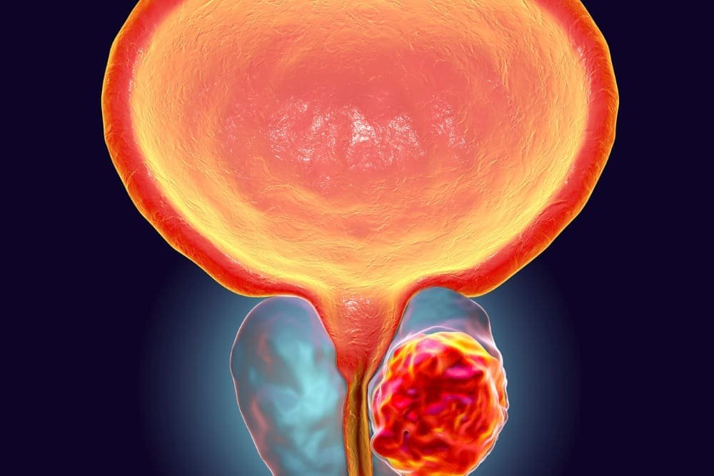 Enucleación prostática con láser de holmio (HoLEP) en CDMX: Tratamiento avanzado para la hiperplasia prostática